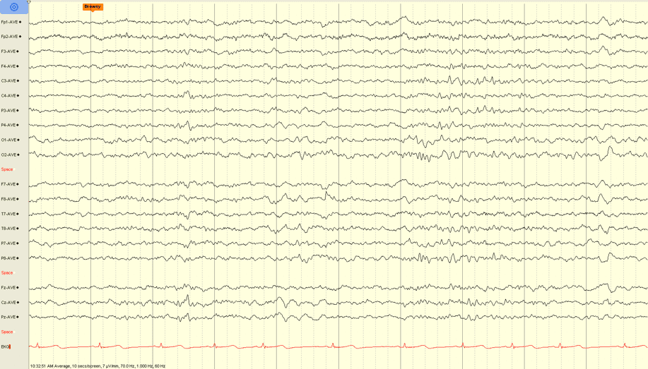 Learn to Read EEG , with practice questions! | NowYouKnow Neuro