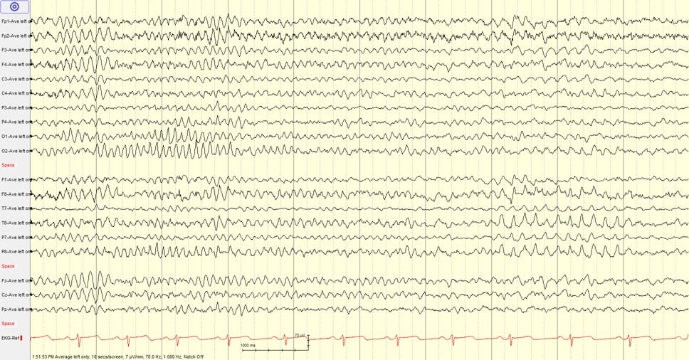 Learn to Read EEG , with practice questions! | NowYouKnow Neuro