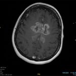 Axial-T1-post-with-classic-GBM-butterfly-lesion-1.jpg