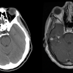 CTH-and-T1-w-contrast-oligodendroglioma.jpg-1.png