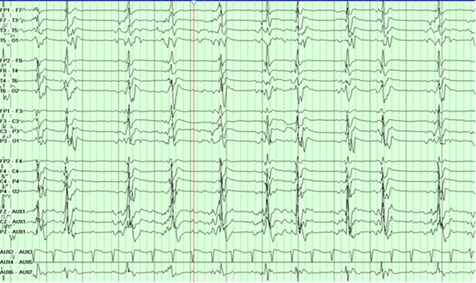Neuroinfectious disease, EEG with GPDs secondary to SSPE