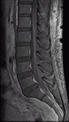 Guillain-Barre Syndrome patient sagittal spinal MRI showing contrast enhancement of the cauda equina and nerve roots