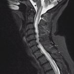 LETM_NMO_MRI_sagital_STIR-1.jpg