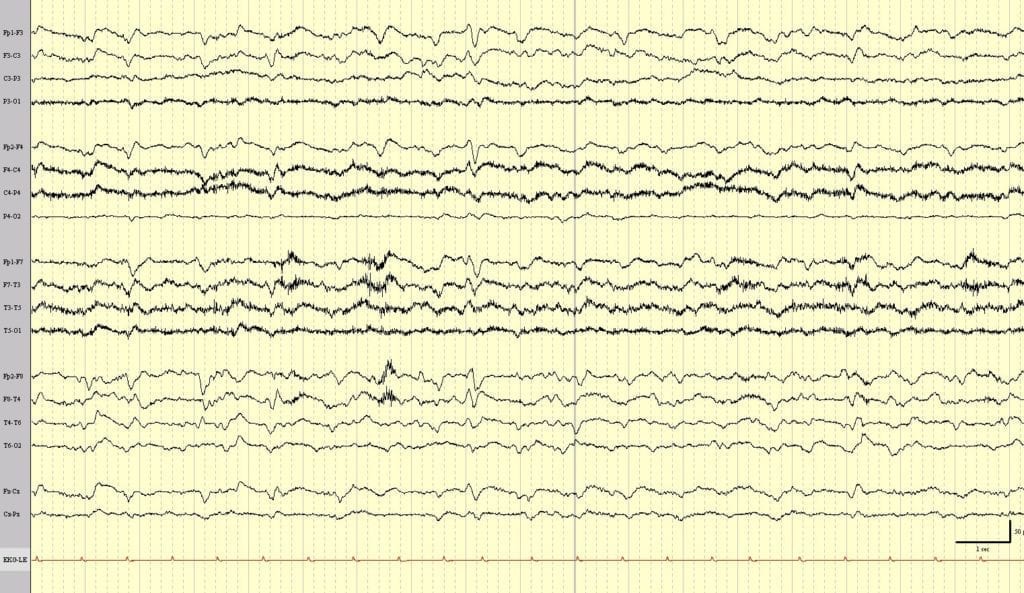 EEG review lithium toxicity encephalopathy with multifocal sharps