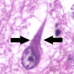 Neurofibrillary-tangle-in-Alzheimers-disease-1.jpg