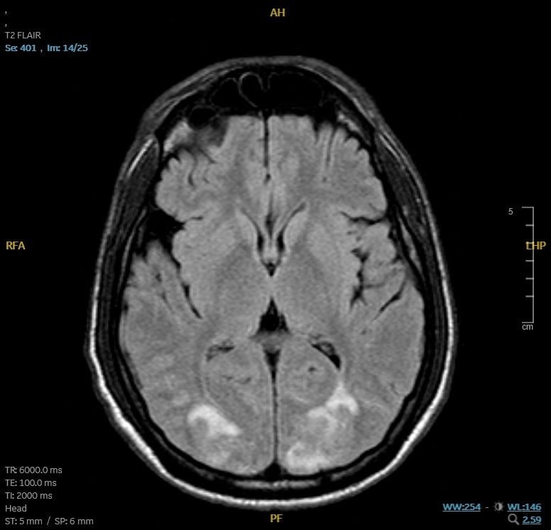 T2 FLAIR MRI, axial cut, showing bilateral posterior predominant subcortical hyperintensities consistent with posterior reversible encephalopathy syndrome (PRES)