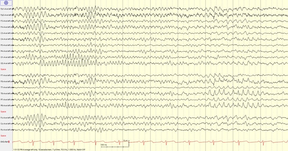 Learn To Read Eeg , With Practice Questions! 