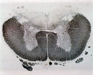 spine anatomy pathology disease board review RITE tabes dorsals syphilis