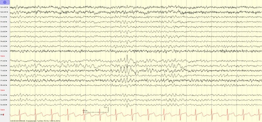 Learn to Read EEG , with practice questions! | NowYouKnow Neuro