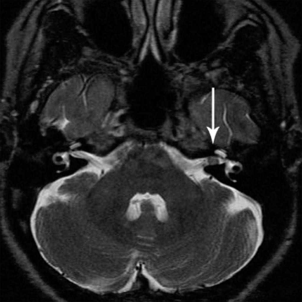 Acoustic Schwannoma