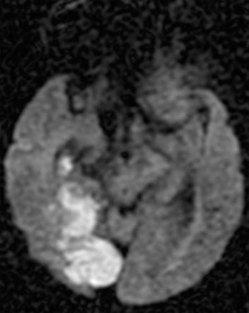Acute Right PCA Stroke
