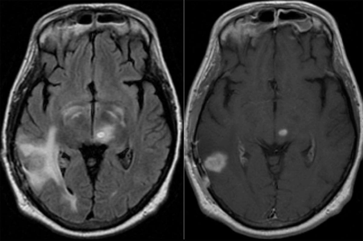 Neuroinfectious disease Aspergillosis