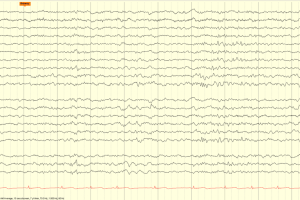 14 and 6 Hz Positive Spikes 14 and 6 positive spikes on EEG tracing