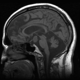 Hypothalamic Hamartoma Sagittal MRI with Hypothalamic Hamartoma