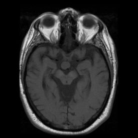 Hypothalamic Hamartoma Axial MRI with Hypothalamic hamartoma