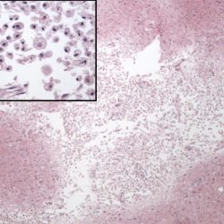 36 Hours Post Cerebral Infarct Microscope pathology slide of brain tissue 36 Hours Post Cerebral Infarct