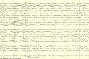 6 Hz Spikes (14 and 6 Variant) EEG showing 6 Hz Spikes (14 and 6 Variant)