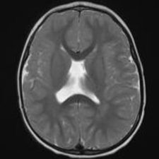 Septo-optic Dysplasia Brain MRI with absent septum pellucidum in patient with septo-optic dysplasia