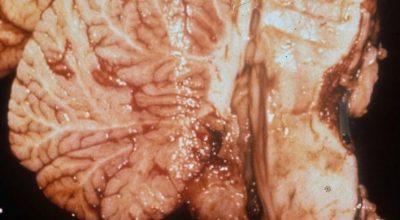 Arnold-Chiari Malformation Gross pathologic specimen of Arnold-Chiari Malformation downward displacement of the vermis and brain stem with beaking of the tectum