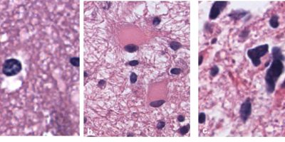 Astrocytes: Normal vs. Reactive vs. Neoplastic Pathology slides of normal, reactive, and neoplastic astrocytes
