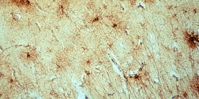 Astrocytes in a Normal Aged Human with GFAP Stain Astrocytes in Normal Aged Cortex on GFAP stain slide