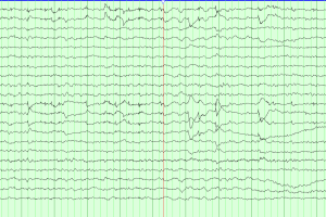 REM Sleep with Lateral Rectus Spikes EEG tracing with REM sleep and lateral rectus spikes on average montage