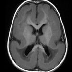 Lissencephaly Axial MRI showing a near-complete absence of cortical sulci in lissencephaly