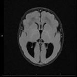 Lissencephaly Axial MRI showing a near-complete absence of cortical sulci in lissencephaly