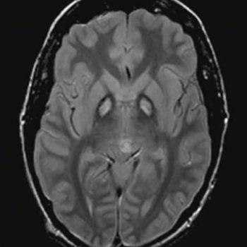Pantothenate Kinase Deficiency Axial MRI, T2 FLAIR, showing increased T2 signal in the bilateral globus pallidi, consistent with iron deposition in Pantothenate Kinase Deficiency