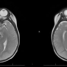 Septo-optic Dysplasia Axial T2 showing underdevelopment of the optic nerve and absence of the septum pellucidum in septo-optic dysplasia