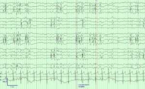Benign Epilepsy with Centro-temporal Spikes (BECTS) EEG showing Benign Epilepsy with Centro-temporal Spikes (BECTS)