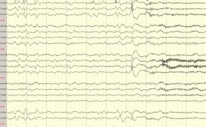 Benign Partial Epilepsy of Childhood with Centrotemporal Spikes (BECTS) Epilepsy Benign partial epilepsy of childhood with centrotemporal spikes (BECTS) on EEG tracing