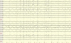 Benign Epilepsy of Childhood with Centrotemporal Spikes (BECTS) EEEG tracing showing epilepsy patient with Benign partial epilepsy of childhood with centrotemporal spikes