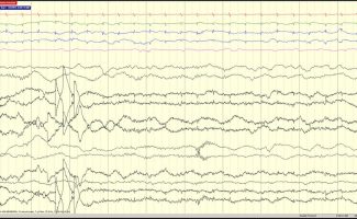 Delta brush EEG with Delta brush