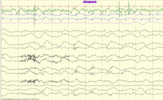 Delta Brush EEG review tracing with delta brush