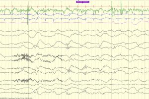 Delta Brush EEG review tracing with delta brush