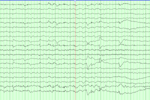 REM Sleep with Lateral Rectus Spikes EEG tracing with REM sleep and lateral rectus spikes on bipolar montage