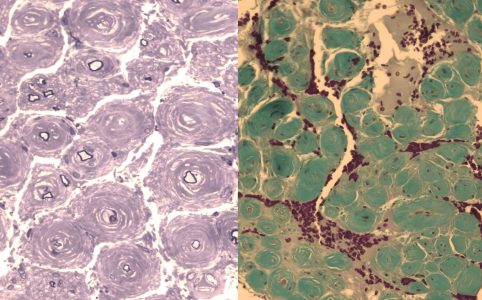 CIDP with Onion Bulbs Nerve biopsy of a patient with CIDP showing onion bulb pathology