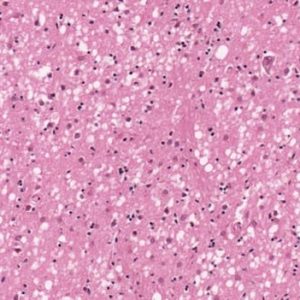 Spongiform Encephalopathy H&E stain showing many small round vacuoles consistent with spongiform encephalopathy