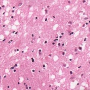 Spongiform Encephalopathy H&E stain showing many small round vacuoles consistent with spongiform encephalopathy.