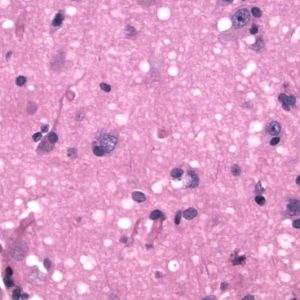 Spongiform Encephalopathy (CJD) H&E stain showing many small round vacuoles consistent with spongiform encephalopathy.
