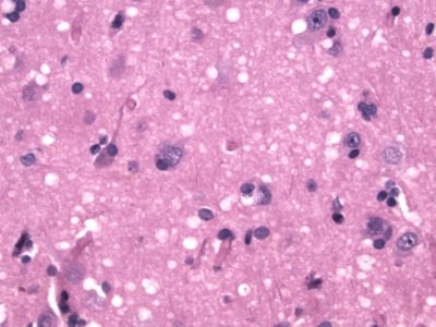 Spongiform Encephalopathy (CJD) H&E stain showing many small round vacuoles consistent with spongiform encephalopathy.