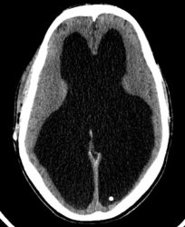 Congenital Aqueductal Stenosis Congenital aqueductal stenosis on CT head with ventriculomegaly