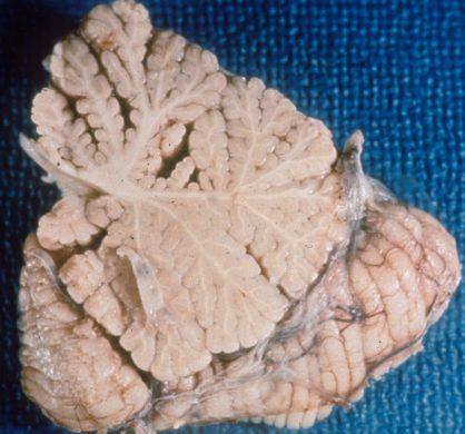 Cerebellar Atrophy Gross section of cerebellum with atrophy