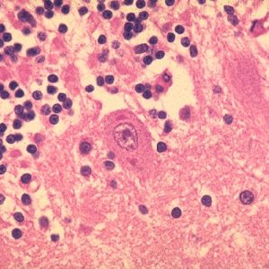Rabies H&E stained pathology biopsy showing two eosinophilic Negri bodies within a Purkinje cell consistent with Rabies
