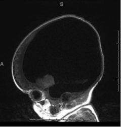 Ventriculomegaly Sagittal MRI showing severe ventriculomegaly in a 37-week patient.