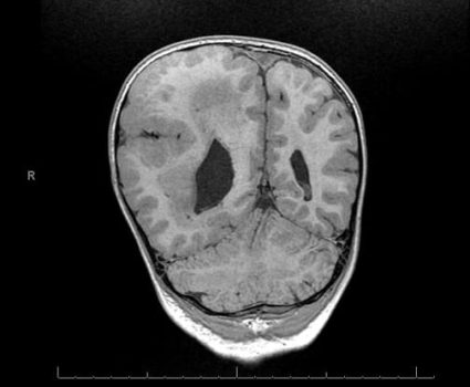 Hemimegalencephaly Hemimegalencephaly on Coronal MRI showing marked parenchymal thickening and asymmetry secondary to excessive neuronal proliferation