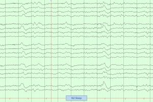 Stage N2 Sleep on EEG Stage N2 Sleep on EEG