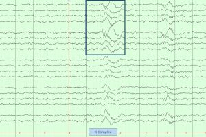 K Complex on EEG EEG tracing showing a K complex during stage N2 sleep