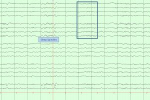 Sleep Spindles on EEG EEG with stage N2 sleep with sleep spindles